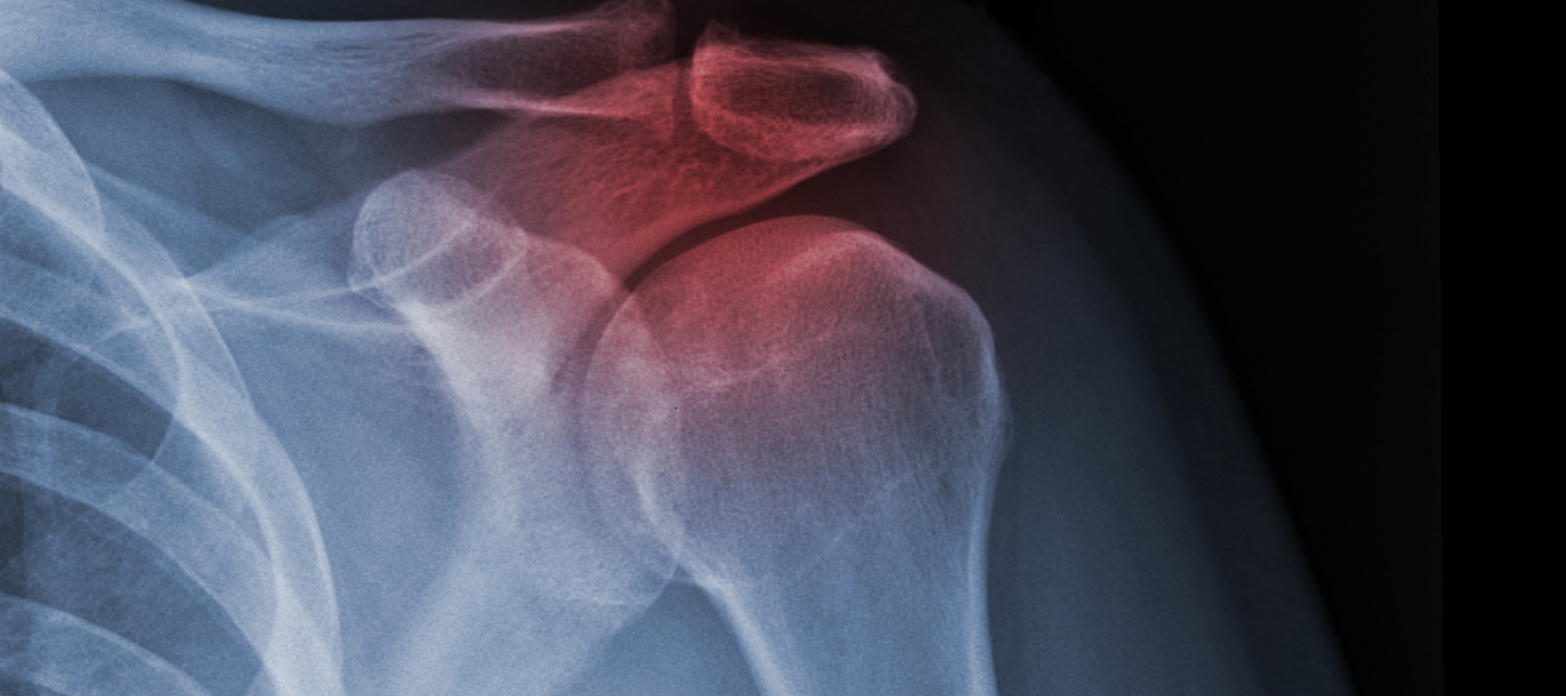 x-ray of human shoulder; radiation therapy program