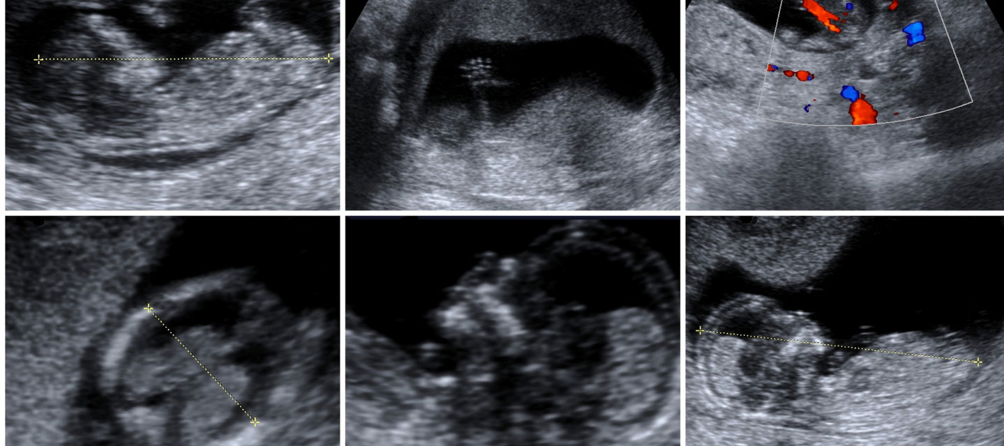 six sonographic images of a of an infant; diagnostic medical sonography